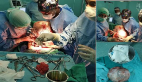 استئصال ورم ضخم من بطن امرأة في الرشيدية بلغ وزنه 14 كلغ